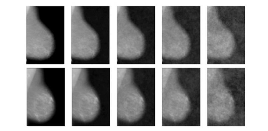 radiologists interpret mammogram image details as breast calcifications or abnormal masses with varying degrees of confidence and accuracy