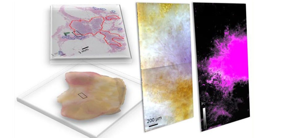 Freshly dissected tissue (lower left) and its pathology-prepared slide with identified tumor regions