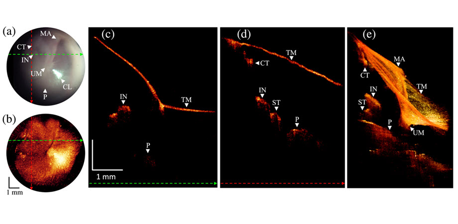 A newly developed otoscope incorporates combines the familiar otoscopic view with high-resolution imaging of the inner structures of the TM and middle ear, offering a clearer and more comprehensive view.