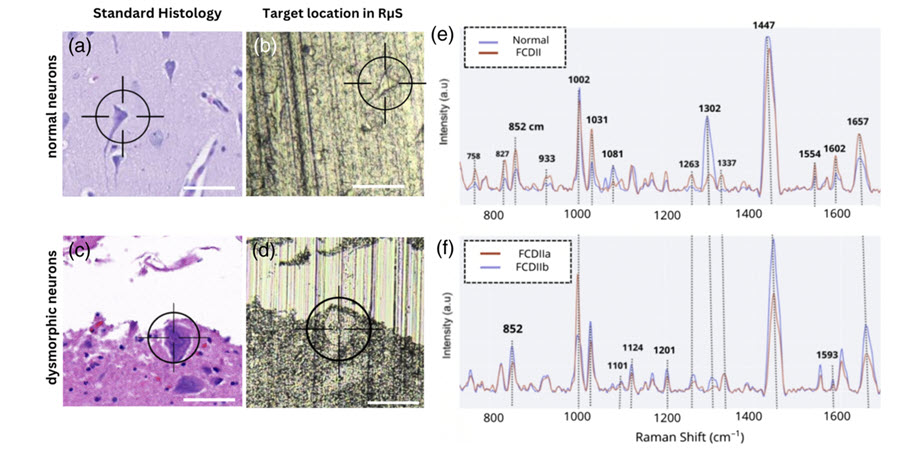 Raman spectroscopy distinguishes normal brain tissue from dysplastic tissue in single-cell analysis